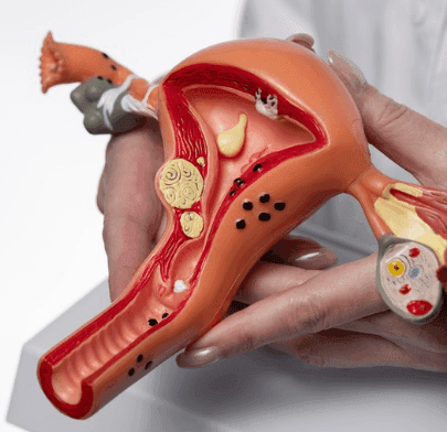 Laparoscopic Ovarian Cystectomy