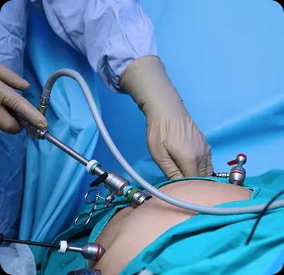 Laparoscopic Surgery