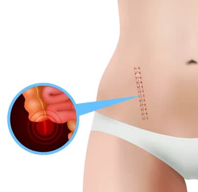 https://dxfqlcpql5f3t.cloudfront.net/Treatment/appendectomy.webp