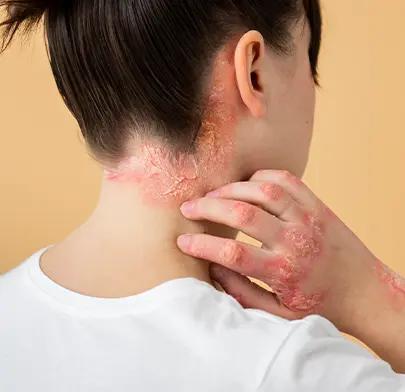 https://dxfqlcpql5f3t.cloudfront.net/Treatment/juvenile-dermatomyositis.webp