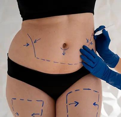 https://dxfqlcpql5f3t.cloudfront.net/Treatment/liposuction.webp