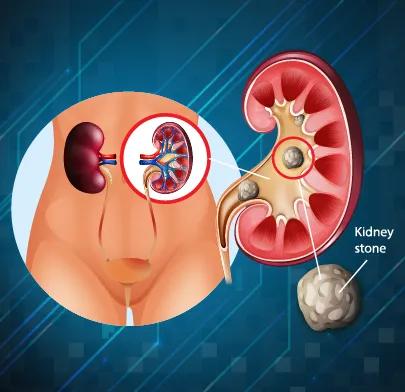 https://dxfqlcpql5f3t.cloudfront.net/Treatment/lithotripsy.webp