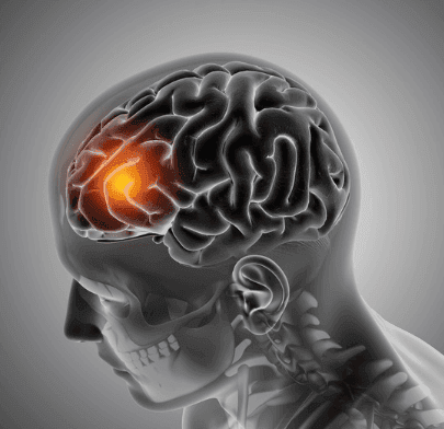 Transient Ischemic Attack (TIA) Prevention