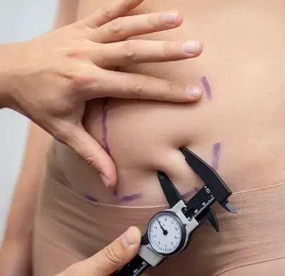 Abdominoplasty