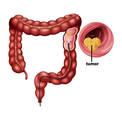 Medical illustration of the colon with a highlighted tumor, depicting signs of Colon Cancer.