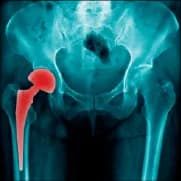 What Hip Replacement Surgery Costs in Chennai Today?