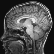 How Much Does Brain Tumour Surgery Cost in India?