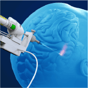 Why Patients Choose Robotic Brain Tumour Surgery in India Now