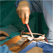 Kidney Transplant Success Rate by Age: What to Expect