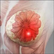 Find the Best Breast Cancer Treatment Options in India