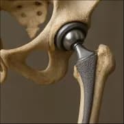 Your Guide to a Successful Hip Joint Replacement