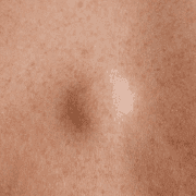 Lipoma vs Other Lumps: Key Differences You Should Know
