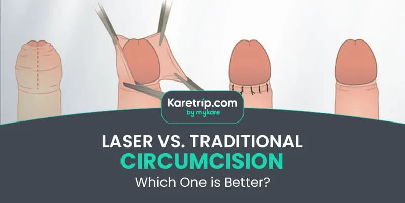 Laser vs. Traditional Circumcision Which One is Better 