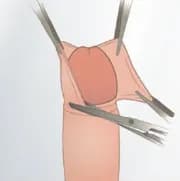 Laser vs. Traditional Circumcision: Which One is Better? 