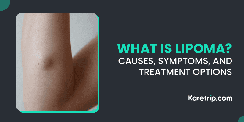 What is Lipoma Causes, Symptoms, and Treatment Options