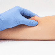 Lipoma Treatments: From Observation to Surgical Removal