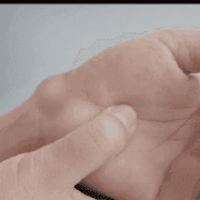 Lipomas and Overall Health: Myths and Facts