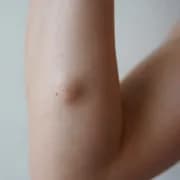 Innovative Lipoma Treatments in Bangalore