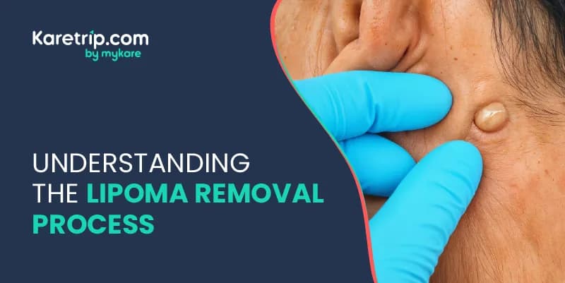Understanding the Lipoma Removal Process