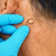 Understanding the Lipoma Removal Process