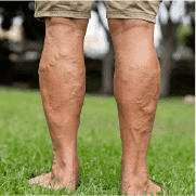 Varicose Veins Treatment: Laser vs Surgery – Which to Choose?