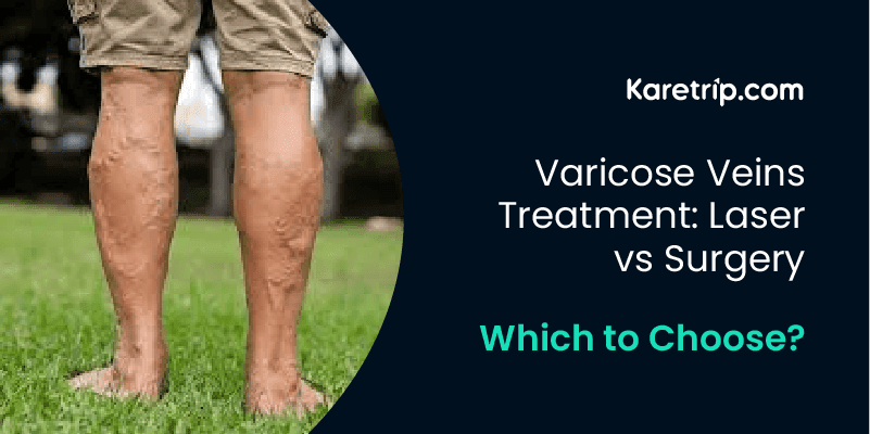 varicose veins treatment