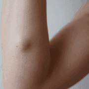 What is Lipoma? Causes, Symptoms, and Treatment Options