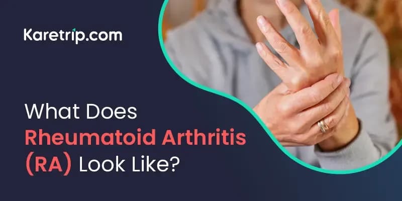 What Does Rheumatoid Arthritis (RA) Look Like